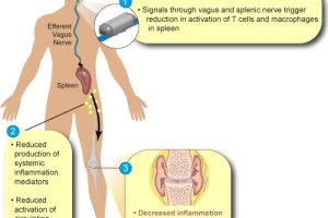 SetPoint Medical nerve stimulation