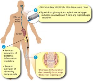 SetPoint Medical nerve stimulation - Bioelectronic nerve stimulator eases rheumatoid arthritis